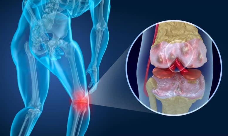 Caminar puede aliviar el dolor de rodilla en personas con artritis – europeantimes.news